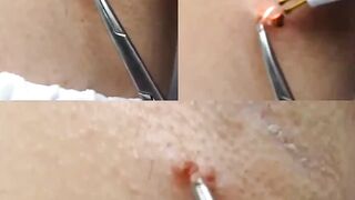 Virtually Painless Skin Tag Removal