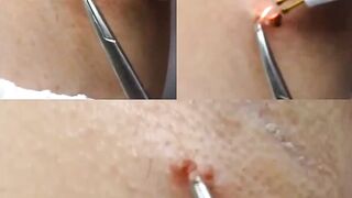 Virtually Painless Skin Tag Removal