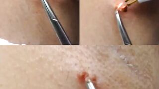 Virtually Painless Skin Tag Removal