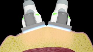 SculpSure Fat Reduction Los Angeles