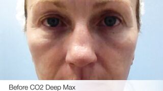 Mixto CO2 Laser Resurfacing Testimonial