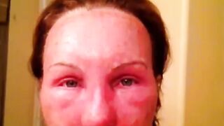 Mixto CO2 Fractional Laser Resurfacing Video Diary