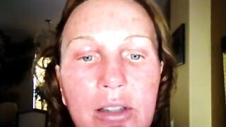 Mixto CO2 Fractional Laser Resurfacing Video Diary