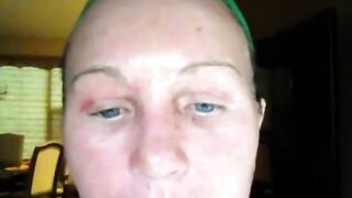 Mixto CO2 Fractional Laser Resurfacing Video Diary