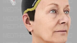 PDO THREAD LIFT TUTORIALS BY MEDITHREAD - 3D CHEEK