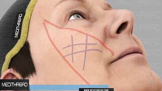 PDO THREAD LIFT TUTORIALS BY MEDITHREAD - 3D CHEEK