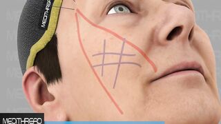 PDO THREAD LIFT TUTORIALS BY MEDITHREAD - 3D CHEEK