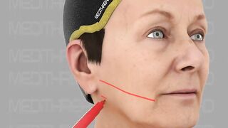PDO-THREAD LIFT TUTORIALS BY MEDiTHREAD - 3D Jowl