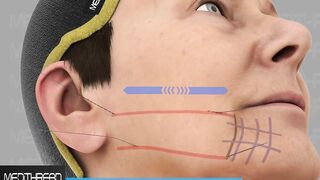 PDO-THREAD LIFT TUTORIALS BY MEDiTHREAD - 3D Jowl