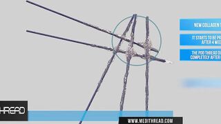 PDO-THREAD LIFT TUTORIALS BY MEDiTHREAD - 3D Jowl