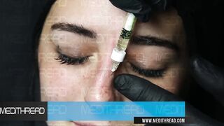 PDO -THREAD LIFT TUTORIAL BY MEDiTHREAD  - NOSE LIFT SCHEMATIC 2