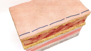 PDO- THREAD LIFT TUTORIAL BY MEDiTHREAD - NECK LIFT