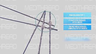 PDO- THREAD LIFT TUTORIAL BY MEDiTHREAD - NECK LIFT