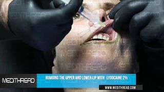 PDO THREAD LIFT TUTORIAL BY MEDiTHREAD - LIPS AND SMOKER LINES