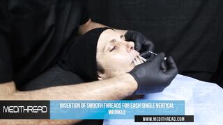 PDO THREAD LIFT TUTORIAL BY MEDiTHREAD - LIPS AND SMOKER LINES