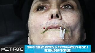 PDO THREAD LIFT TUTORIAL BY MEDiTHREAD - LIPS AND SMOKER LINES