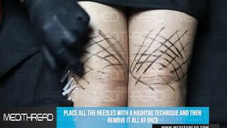 PDO-THREAD LIFT TUTORIAL BY MEDiTHREAD  - KNEE