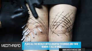 PDO-THREAD LIFT TUTORIAL BY MEDiTHREAD  - KNEE