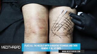 PDO-THREAD LIFT TUTORIAL BY MEDiTHREAD  - KNEE