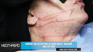 PDO-THREAD LIFT TUTORIAL BY MEDiTHREAD - JAWLINE