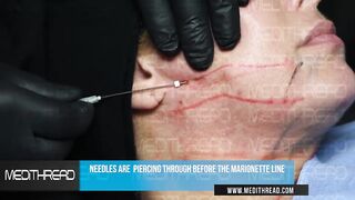 PDO-THREAD LIFT TUTORIAL BY MEDiTHREAD - JAWLINE