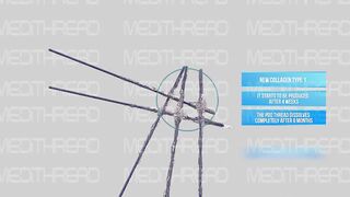 PDO-THREAD LIFT TUTORIAL BY MEDiTHREAD - JAWLINE
