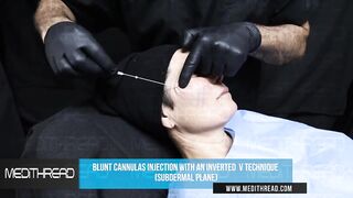 PDO-THREAD LIFT TUTORIAL BY MEDiTHREAD - CHEEK LIFT