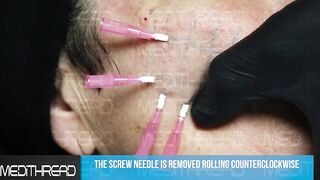 PDO-THREAD LIFT TUTORIAL BY MEDiTHREAD - CHEEK LIFT