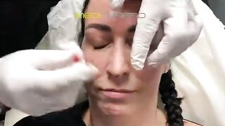 PDO-THREAD LIFT PROCEDURE BY MEDiTHREAD - Nose Lift