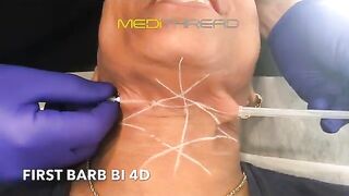 PDO-THREAD LIFT TUTORIAL BY MEDiTHREAD - Neck Lift