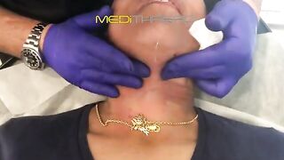 PDO-THREAD LIFT TUTORIAL BY MEDiTHREAD - Neck Lift