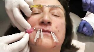 PDO-THREAD LIFT TUTORIAL BY MEDiTHREAD - Smoker Lines & Lip Contour