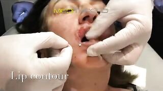 PDO-THREAD LIFT TUTORIAL BY MEDiTHREAD - Smoker Lines & Lip Contour