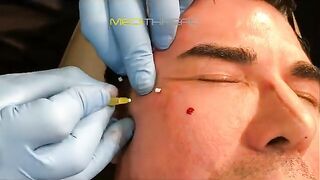 PDO-THREAD LIFT PROCEDURE BY MEDiTHREAD - Eyes