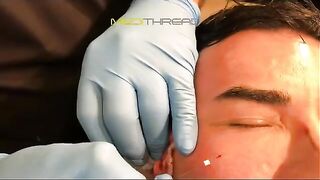 PDO-THREAD LIFT PROCEDURE BY MEDiTHREAD - Eyes