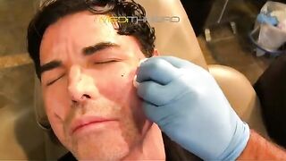 PDO-THREAD LIFT PROCEDURE BY MEDiTHREAD - Eyes