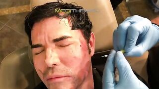 PDO-THREAD LIFT PROCEDURE BY MEDiTHREAD - Eyes