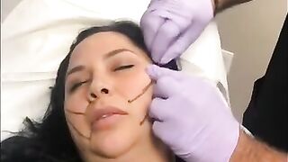 PDO-THREAD LIFT PROCEDURE BY MEDiTHREAD - Cheek Lift