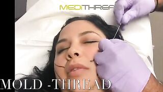 PDO-THREAD LIFT PROCEDURE BY MEDiTHREAD - Cheek Lift