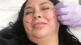 PDO-THREAD LIFT PROCEDURE BY MEDiTHREAD - Cheek Lift