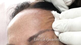 PDO-THREAD LIFT PROCEDURE BY MEDiTHREAD - BROW LIFT  & CROWFEET