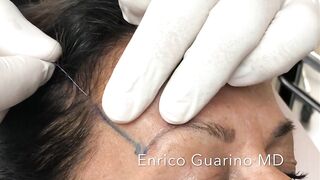 PDO-THREAD LIFT PROCEDURE BY MEDiTHREAD - BROW LIFT  & CROWFEET