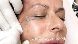 PDO-THREAD LIFT PROCEDURE BY MEDiTHREAD - BROW LIFT  & CROWFEET