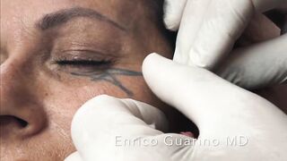 PDO-THREAD LIFT PROCEDURE BY MEDiTHREAD - BROW LIFT  & CROWFEET