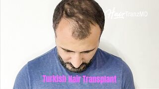 Advanced Turkish Hair Transplant
