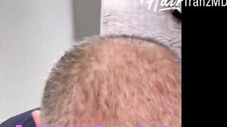 Advanced Turkish Hair Transplant