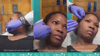 Cheek Lift with PDO Threads