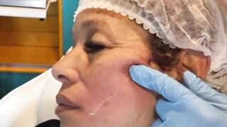 PDO Thread Lift Live procedure - Z-Lift