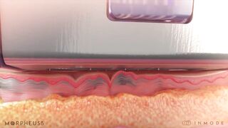 RF Microneedling