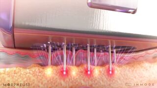 RF Microneedling